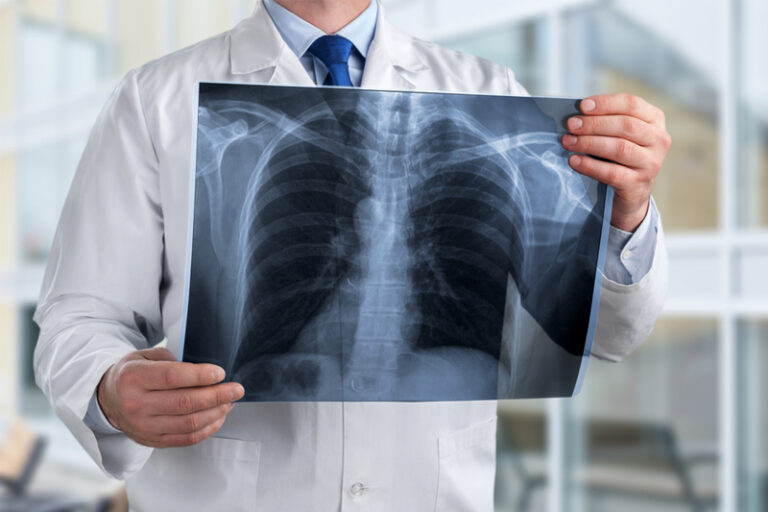 60多歲女不煙不酒 體檢發現肺部有陰影 求醫揭患肺癌三期 術後免疫治療助減復發率