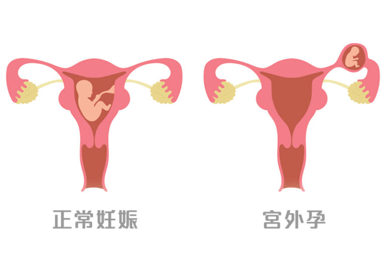 宮外孕原因-異位妊娠-症狀-徵兆-手術-藥物治療方法-宮外孕復發-正常懷孕率-婦產科專科方秀儀醫生