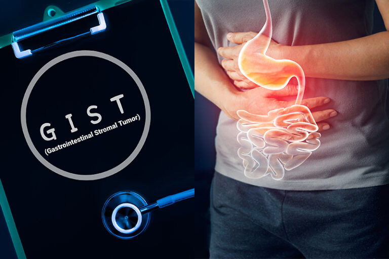 胃腸道間質瘤-癌症-症狀-診斷-治療-cancercare-hk