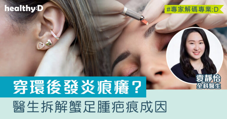 蟹足腫｜穿環紋身霧眉後發炎痕癢？醫生拆解3類人士要小心