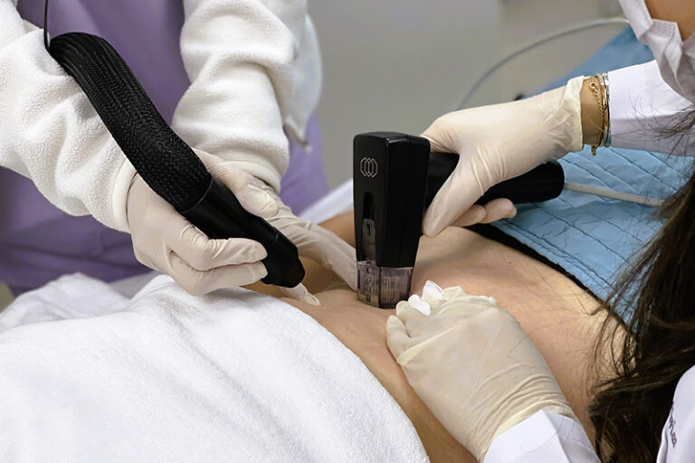 妊娠紋消除-修復-皮膚擴張紋-鄭曉蔚醫生