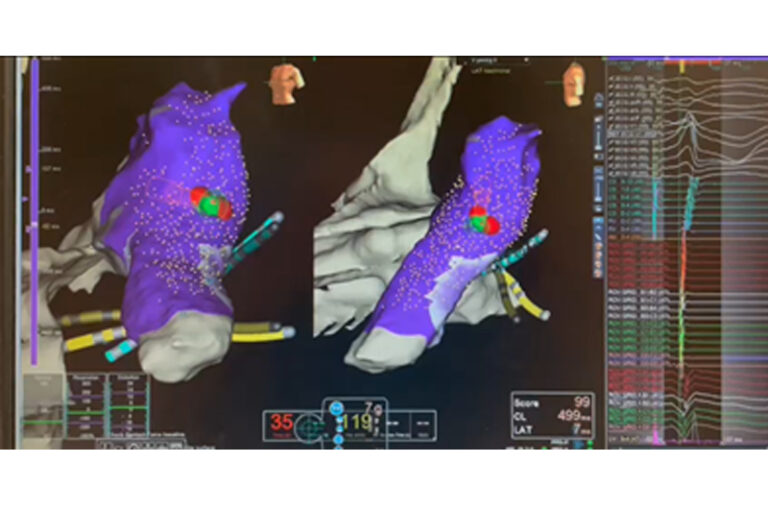 心律不整-室上性心動過速-心臟專科陳杰醫生