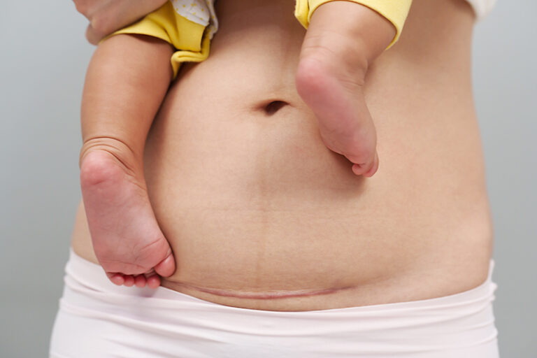 順產-剖腹-利弊-婦產科方秀儀醫生