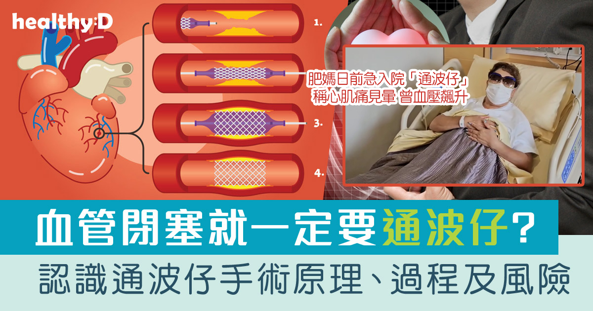 通波仔 | 呼吸急速、胸口壓著可能是冠心病症狀!認識通波仔手術原理、過程、風險及復發機會 | healthyD.com