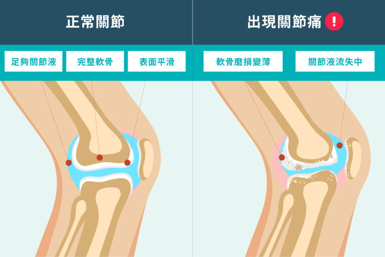 關節磨蝕原因-關節保健品推薦-骨關節痛