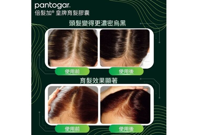 產後掉髮-頭髮保健品推介-男女脫髮原因-育髮保健品-維他命Supplement-品牌-成分-價錢-防掉髮保養必學方法-