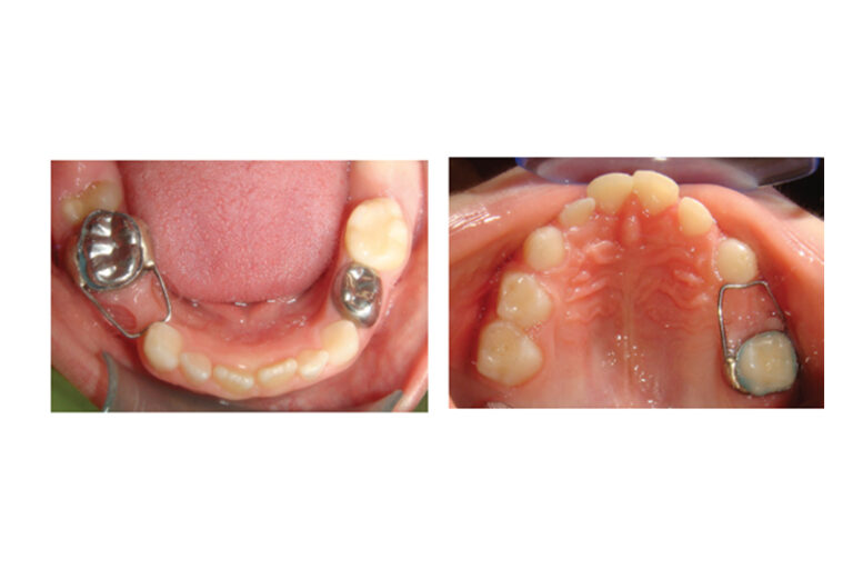 兒童乳牙過早脫落怎麼辦?間隙保持器是甚麼?牙醫拆解需要佩戴2大情況