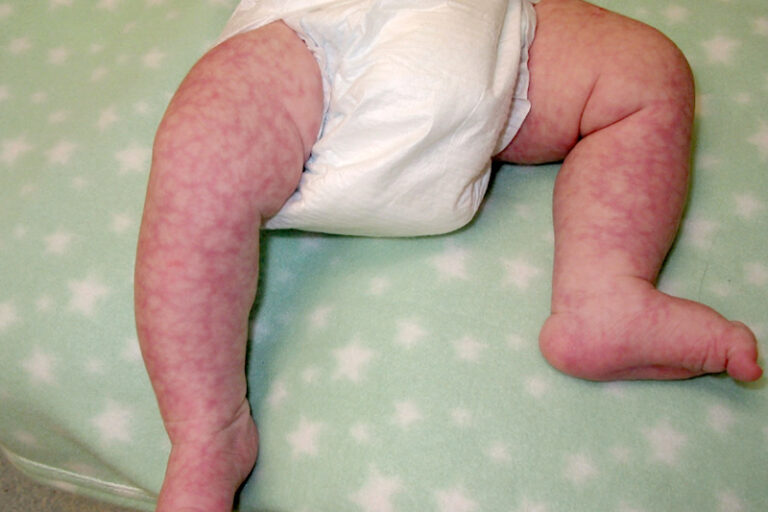 天氣轉冷BB手腳皮膚出現大理石紋?兒科醫生:紋路若不消失或與4種疾病相關