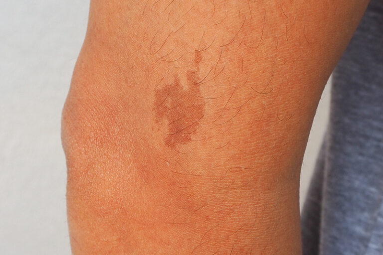 咖啡牛奶斑-Cafe au lait macule-黑色胎記種類-先天黑色素痣病變-胎記治療-兒科徐梓筠醫生