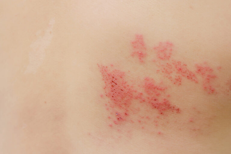 生蛇傳染-帶狀皰疹-水痘-生蛇原因-症狀-治療