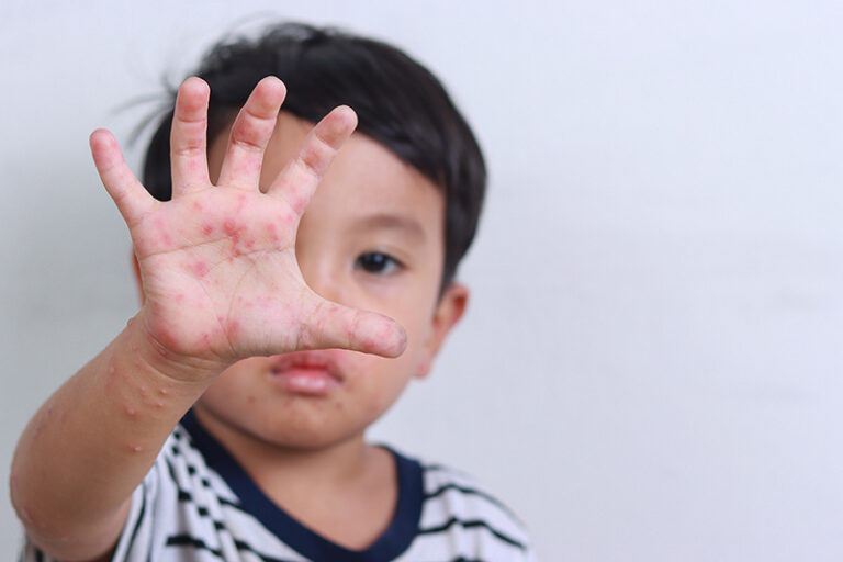 生蛇傳染-帶狀皰疹-水痘-生蛇原因-症狀-治療