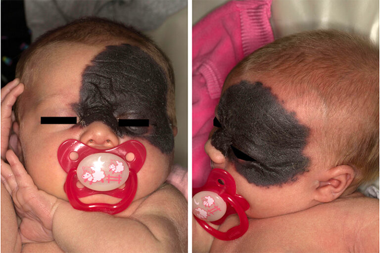 先天黑色素痣-Congenital-Melanocytic-Nevus-(CMN)-黑色胎記種類-先天黑色素痣病變-胎記治療-兒科徐梓筠 醫生