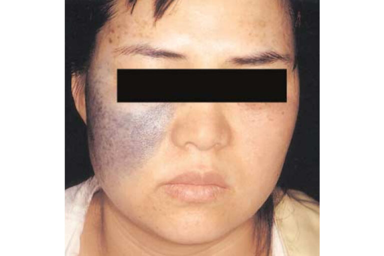 太田母斑 Nevus of Ota-黑色胎記種類-先天黑色素痣病變-胎記治療-兒科徐梓筠醫生