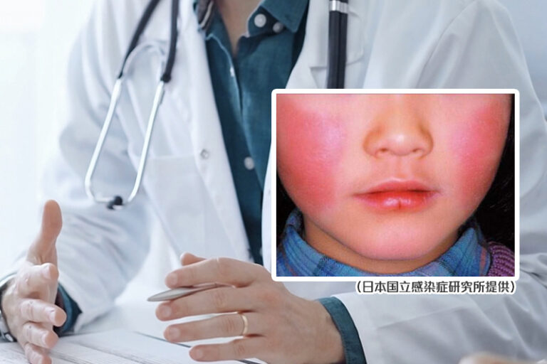 遊日注意｜東京爆蘋果病 個案創新高｜小朋友易中招　孕婦感染可致流產