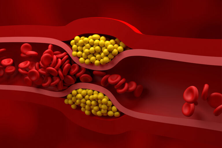 降膽固醇食物 | 膽固醇超標是都市慢性殺手!高膽固醇會遺傳?醫生拆解成因、治療及有效降低血脂的改善方法