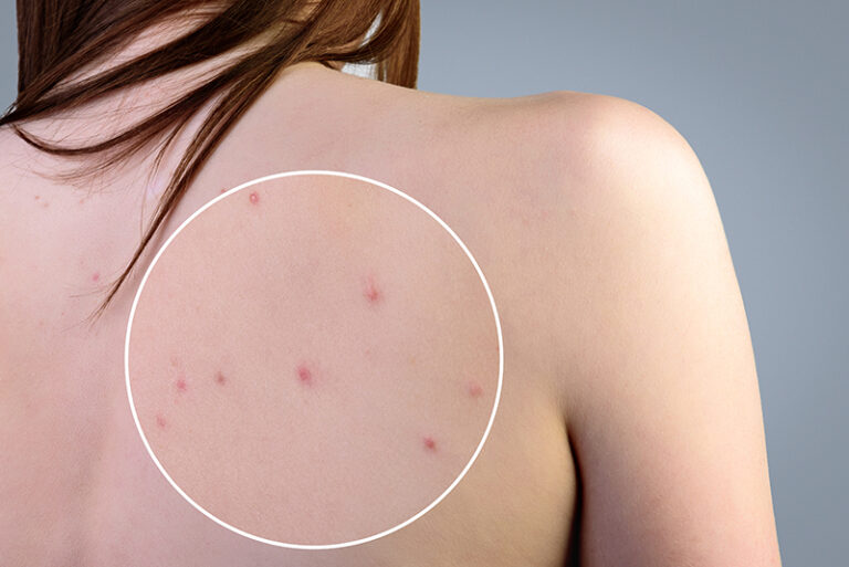 痤瘡-暗瘡位置反映痤瘡成因-暗瘡症狀-陳志勇中醫師