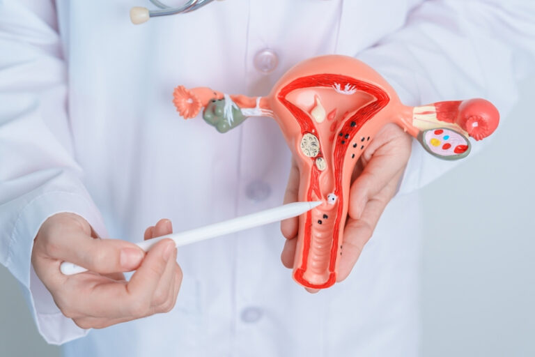 朱古力瘤|中大研究揭治療子宮內膜異位症新靶點|乾眼症藥物「舊藥新用」 助抑制異位內膜組織生長