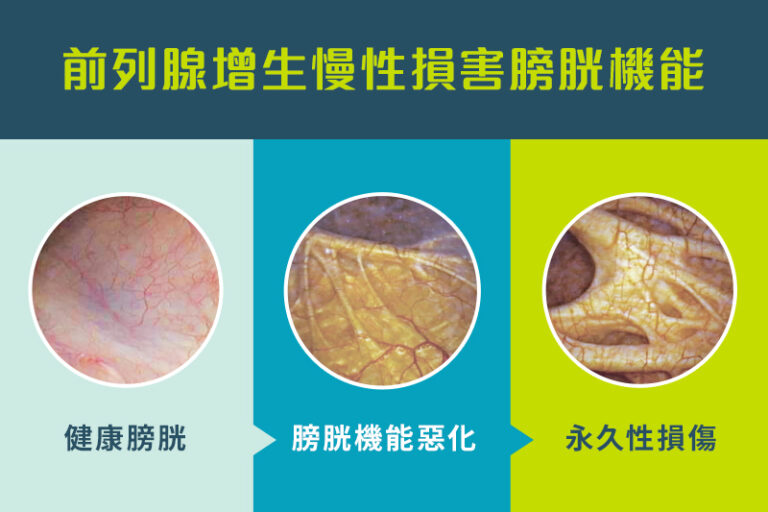 尿頻-排尿困難-前列腺增生-前列腺肥大-前列腺提拉術