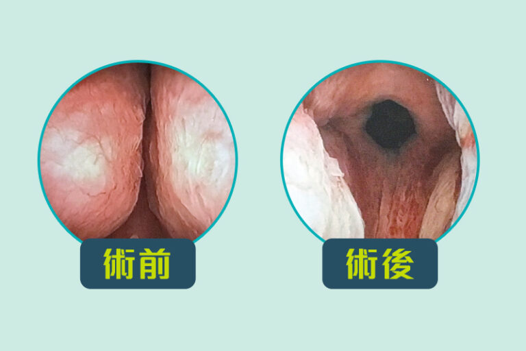 尿頻-排尿困難-前列腺增生-前列腺肥大-前列腺提拉術