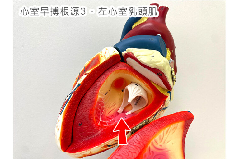 左心室乳頭肌—紅色箭咀指示位置