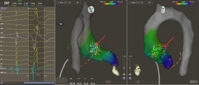 ▲「心臟三維電解剖標測 」(Electroanatomical mapping) - 左心室乳頭肌心室早搏三維電解剖標測。紅色圓點是成功消融靶點。