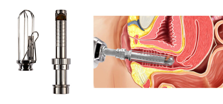 陰道支架(speculum) ，激光機頭(laser handpiece) ，進行陰道回春。