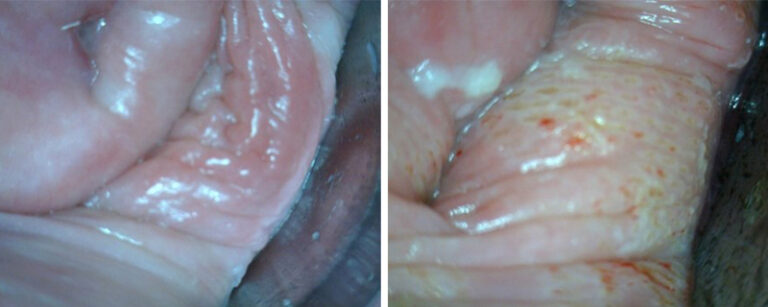 二氧化碳激光治療前後陰道壁情況。