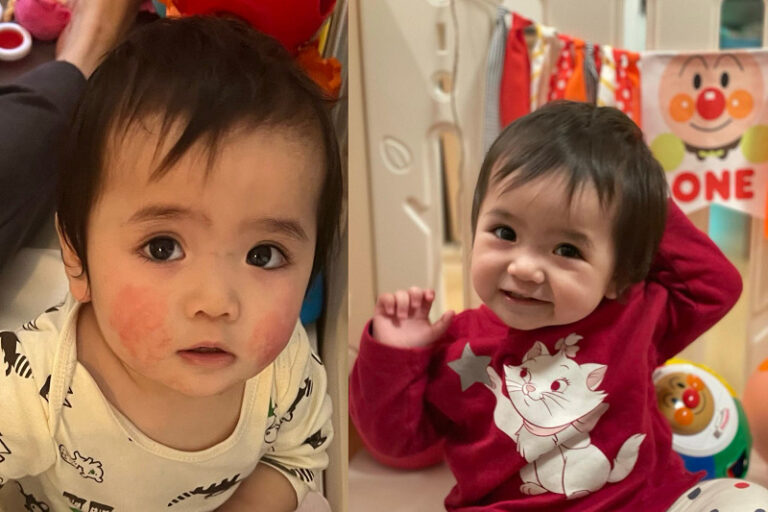 皮膚敏感紅疹-皮膚泛紅-預防皮膚泛紅