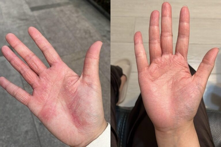 皮膚敏感紅疹-皮膚泛紅-預防皮膚泛紅