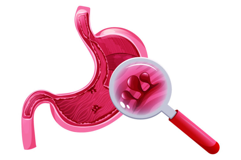 胃瘜肉-類型-癌變-cancercare-hk