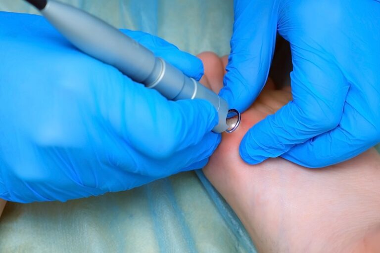 脫疣-皮膚疣-HPV