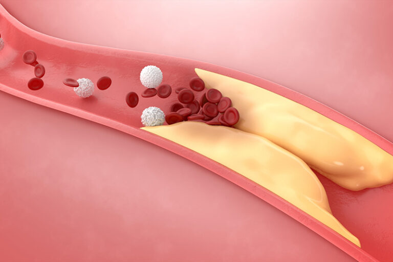 冠心病-動脈粥樣硬化-成因-病理-預防-心臟專科陳麒尹醫生