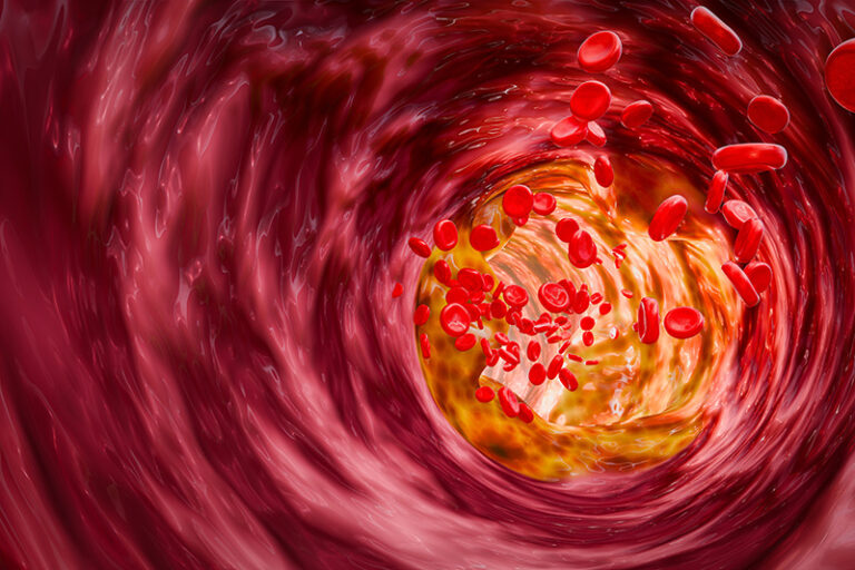 慢性發炎加速血管阻塞或引發冠心病-高危群組-心臟科專科陳麒尹醫生