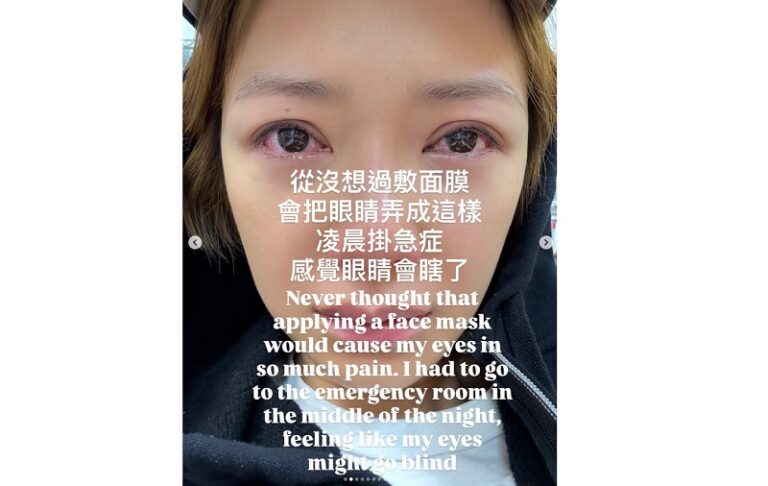 敷面膜-眼睛健康-紅腫-劇痛