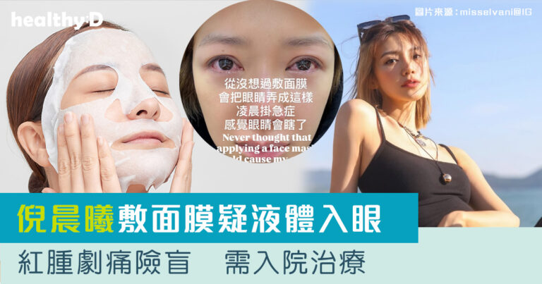 敷面膜｜倪晨曦敷面膜疑液體入眼致紅腫劇痛　險失明需入院治療