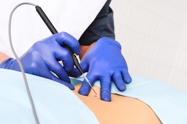 黑色素瘤皮膚癌-手掌腳底黑痣-指甲黑線-黑色素瘤成因-症狀-治療-預防-皮膚科胡惠福醫生