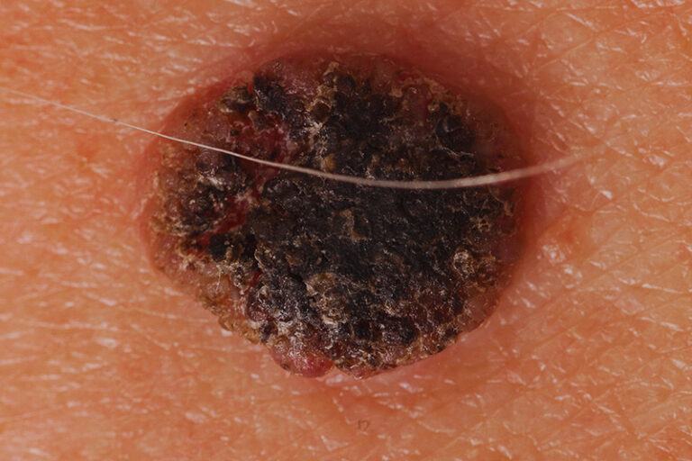 黑色素瘤皮膚癌-手掌腳底黑痣-指甲黑線-黑色素瘤成因-症狀-治療-預防-皮膚科胡惠福醫生