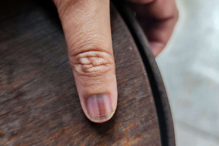 黑色素瘤皮膚癌-手掌腳底黑痣-指甲黑線-黑色素瘤成因-症狀-治療-預防-皮膚科胡惠福醫生