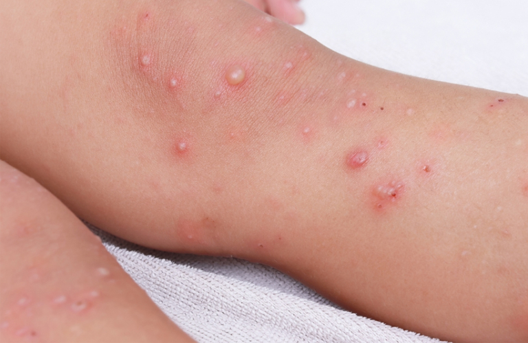 手足口病症狀｜病毒感染無分年齡！喉嚨痛、發燒？兒童手足口病亦可感染成人