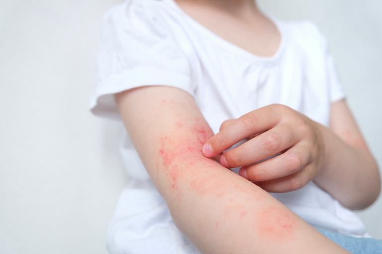 兒童濕疹個案-中醫根治治療