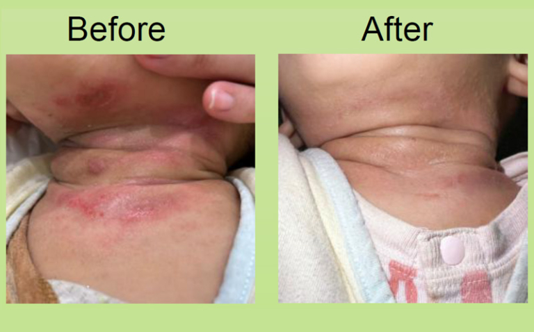 兒童濕疹個案-中醫根治治療