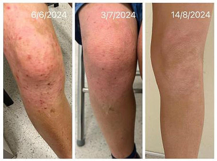 兒童濕疹個案-中醫根治治療