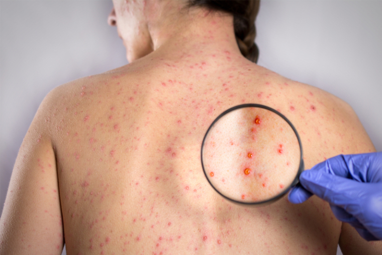 帶狀疱疹生蛇病毒｜化療癌症患者生蛇風險可高達25倍　甚或需中斷治療及面對嚴重併發症