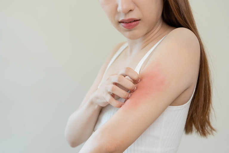 免疫力較弱人士皮膚痕癢