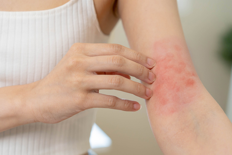 濕敏體質人士一轉天氣皮膚屏障失衡