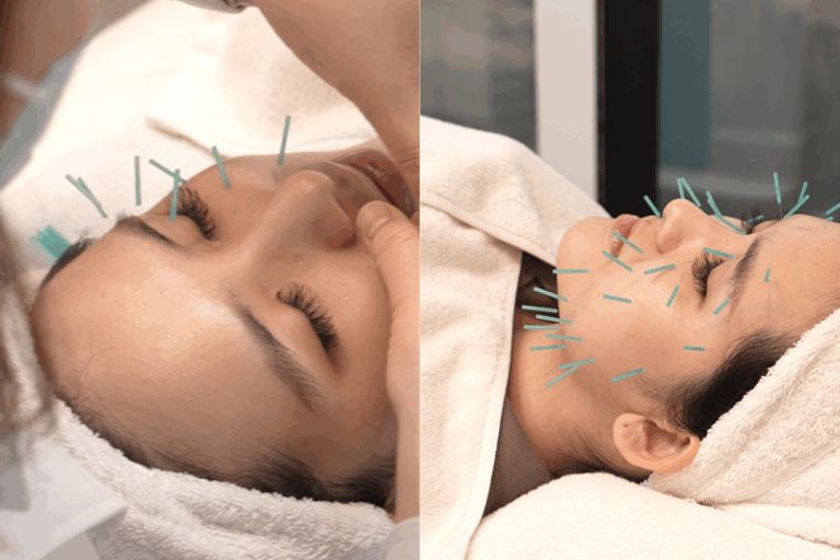 中醫診所推薦 | 中醫走進美容界！美顏針/暗瘡/抗衰老/皮膚護理/修面提拉 由內而外調理養生