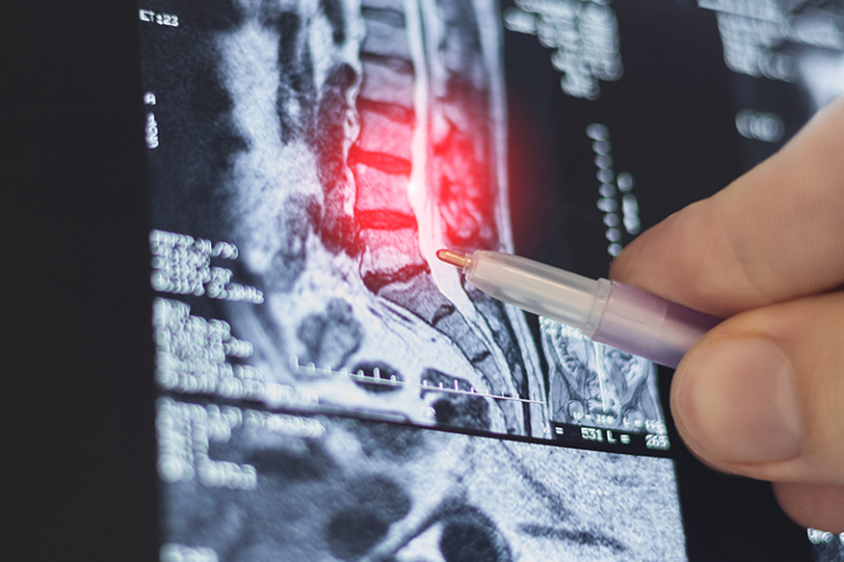 脊醫拆解椎間盤突出年輕化6大成因