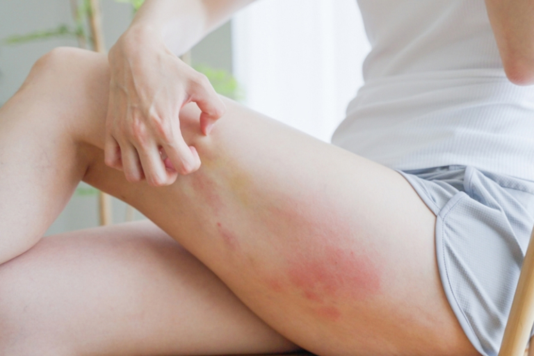 風癩｜生風癩點算？風癩如何止痕？中醫詳解風疹成因及改善方法