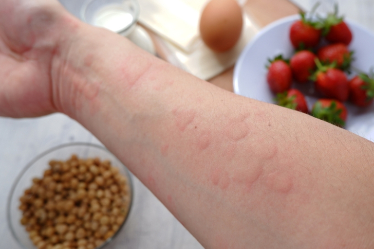 風癩｜生風癩點算？風癩如何止痕？中醫詳解風疹成因及改善方法