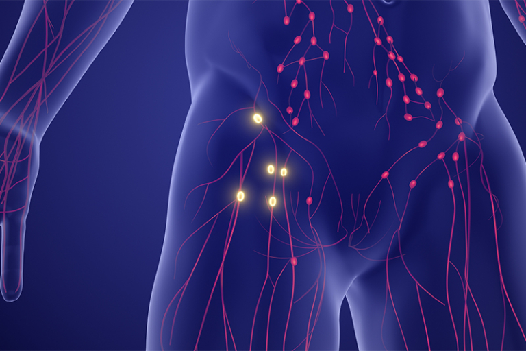 發燒疲倦-夜間盜汗-淋巴癌-症狀-原因-治療-cancercare.hk